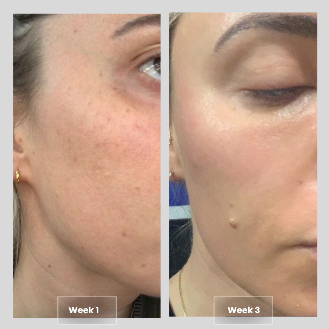 Smooth, firm and plump stubborn areas with Micro-Infusion Targeted Patches