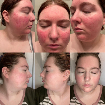 Soothe redness and hydrate deeply - 3H Relief Cream